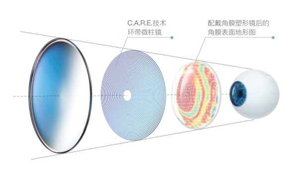 蔡司小乐圆镜片设计受角膜塑形镜视觉信号的启发